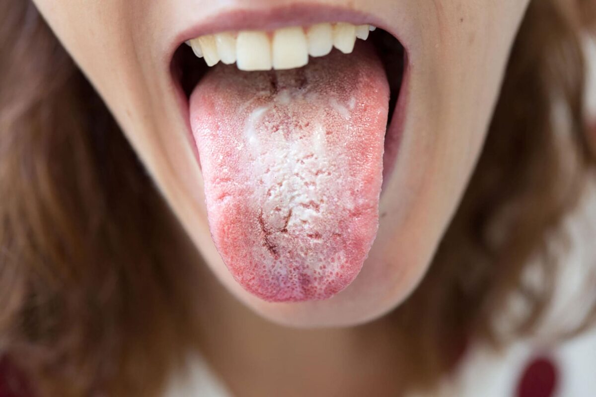 candida-orale-1200x800.jpg