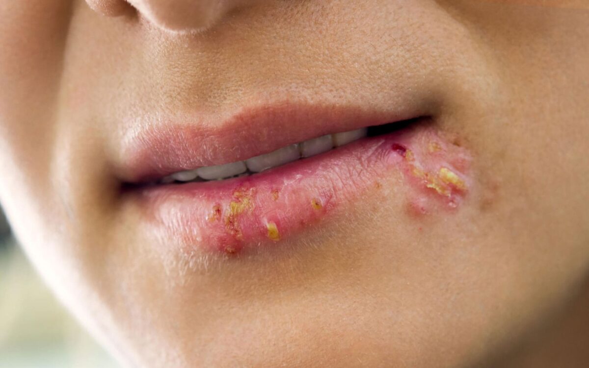 herpes-labiale-1200x751.jpg
