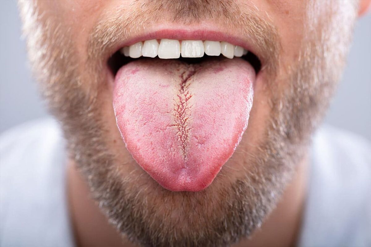 leucoplachia-lingua-1200x800.jpg